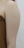 Arm liposuction — before (7days) · Seoul During Clinic