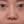 ผ่าตัดแก้ไขผนังกั้นช่องจมูกคด (Septoplasty) — ก่อนทำ (14วัน) · คลินิกโคบิจู