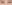 裏ハムラ法（経結膜的眼窩脂肪移動術） — ファクト美容外科クリニック
