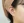 ฟิลเลอร์ติ่งหู (เสริมติ่งหู / หูมงคล) — หลังทำ · คลินิกยูพิค สาขาซองโด