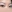 buried suture (non-incisional) double eyelid surgery — Yellow Plastic Surgery Clinic