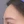 Full-face filler (full-face HA rejuvenation) — before · U&I Clinic - Yeongdeungpo Branch
