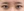 incisional double eyelid surgery — after (7days) · iLumi Plastic Surgery Clinic