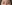 Ptosis Correction (levator surgery / eye-shape correction) — Wink Plastic Surgery Clinic