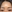Forehead Lift (brow lift, commonly endoscopic) — Heat Plastic Surgery Clinic