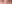 裏ハムラ法（経結膜的眼窩脂肪移動術） — プレジャー美容外科クリニック