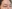 upper blepharoplasty (upper eyelid lift) — Oneul Plastic Surgery Clinic
