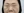 ฟิลเลอร์ใต้ตา (แก้ร่องใต้ตา / ขอบตาคล้ำ) — หลังทำ · ไอแบ็ค คลินิก