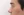 Short nose correction (nose lengthening / derotation) — after (14days) · iLumi Plastic Surgery Clinic