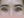Botox for nasolabial folds — before (30days) · K-Tox Clinic - Incheon Guwol Branch