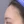 Full-face filler (full-face HA rejuvenation) — after · U&I Clinic - Yeongdeungpo Branch