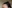 Forehead reduction (hairline lowering surgery) — Uri Plastic Surgery Clinic