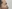 鼻尖形成術（自家軟骨移植） — コ・アン・ミ美容外科クリニック