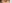 裏ハムラ法（経結膜的眼窩脂肪移動術） — ジャスト美容外科クリニック