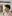 Double chin liposuction (submental liposuction) — Seoul During Clinic
