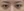 incisional double eyelid surgery — after (7days) · iLumi Plastic Surgery Clinic