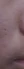 acne scar subcision / regenerative needling — before (42days) · Haneulche Korean Medicine Clinic - Daejeon Branch