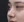 Protruding mouth correction (anterior segmental osteotomy / orthodontic setback) — after (30days) · ES Cheongdam Plastic Surgery Clinic