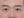 incisional double eyelid surgery — after (3days) · J.O. Plastic Surgery Clinic