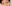 切開法（全切開法二重術） — エイペックス美容外科クリニック