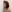 Double chin liposuction (submental liposuction) — Soda Plastic Surgery Clinic