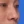 ผ่าตัดแก้ไขผนังกั้นช่องจมูกคด (Septoplasty) — ก่อนทำ (14วัน) · คลินิกโคบิจู