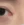acne scar subcision / regenerative needling — after (60days) · Rodam Korean Medicine Clinic - Gangnam Branch