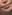 ヒアルロニダーゼ注射（ヒアルロン酸溶解注射） — 本然美容外科クリニック