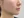 童颜针（舒颜萃/Sculptra）法令纹 — 术后 (30天) · Monster诊所