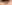 裏ハムラ法（経結膜的眼窩脂肪移動術） — SM美容外科クリニック