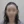 Hairline hair transplant (hairline lowering by grafting) — after (3days) · Vance Mosae Clinic
