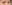 裏ハムラ法（経結膜的眼窩脂肪移動術） — ウィバース美容外科クリニック