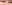 裏ハムラ法（経結膜的眼窩脂肪移動術） — プレジャー美容外科クリニック