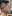 Double chin liposuction (submental liposuction) — Myong Plastic Surgery & Aesthetics