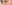 裏ハムラ法（経結膜的眼窩脂肪移動術） — ジャスト美容外科クリニック