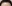 額縮小術（生え際下げ・ヘアライン下降術） — ザフィックス美容外科クリニック