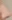 鼻尖形成術（寄贈軟骨使用） — アウラ美容外科クリニック