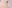 Double chin liposuction (submental liposuction) — Uri Plastic Surgery Clinic
