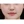 Paranasal (nasal base) augmentation with implant — after (30days) · Soonplus Plastic Surgery & Aesthetics