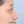 Nasal tip augmentation with donor (acellular) dermal matrix — before (16days) · Thank You Plastic Surgery