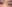 revision eyelid surgery (secondary blepharoplasty) — 1mm Plastic Surgery