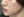 Belotero Revive (HA + glycerol skinbooster) — after (30days) · AB Plastic Surgery & Skin Clinic