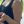 Arm liposuction — before · Gangnam ReSlim Clinic
