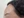 Aegyo-sal filler (under-eye 'love band' / pretarsal roll filler) — after · Monster Clinic
