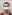 Mini facelift (short-scar, limited-incision facelift) — Wonjin Plastic Surgery Clinic