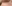 豊胸術（シリコンインプラント／人工乳腺） — SM美容外科クリニック