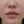 โบท็อกซ์ร่นร่องริมฝีปาก (Lip Flip ทำให้ร่องใต้จมูกดูสั้นลง) — หลังทำ (7วัน) · คลินิก Younme