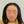 Scalp hair transplant — after (10days) · Okgeon Hairline Clinic