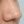 Chemical peel — after (28days) · J.Fill Clinic - Gangnam Branch