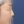 Short nose correction (nose lengthening / derotation) — before (13days) · Yeonse Kyeol Plastic Surgery Clinic